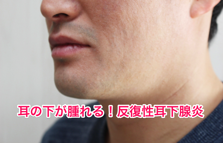 jikasenen.png 反復性耳下腺炎